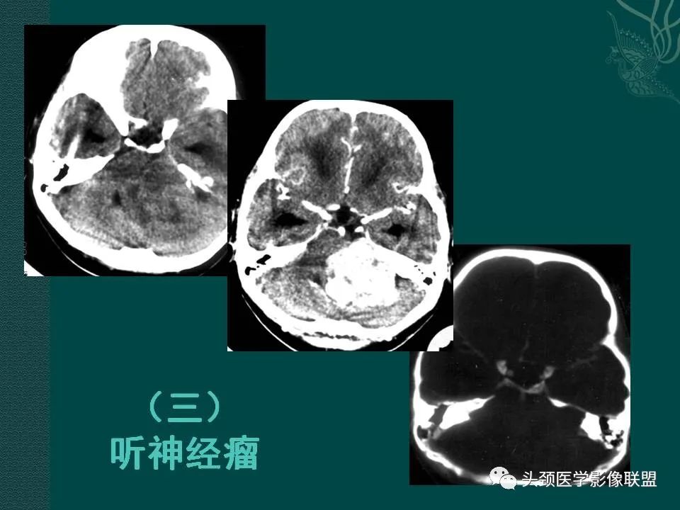【PPT】耳部常见疾病影像表现-52