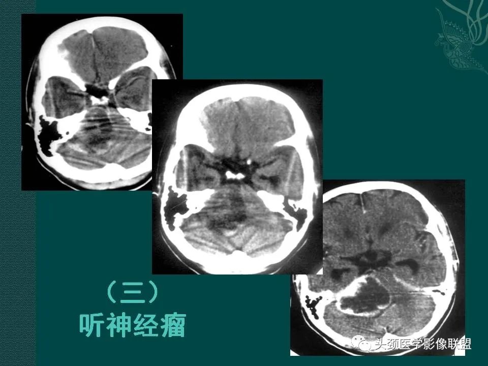 【PPT】耳部常见疾病影像表现-53