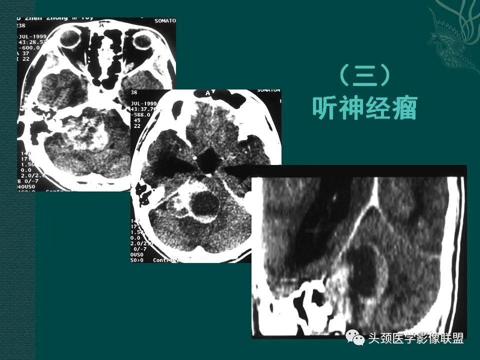 【PPT】耳部常见疾病影像表现-54