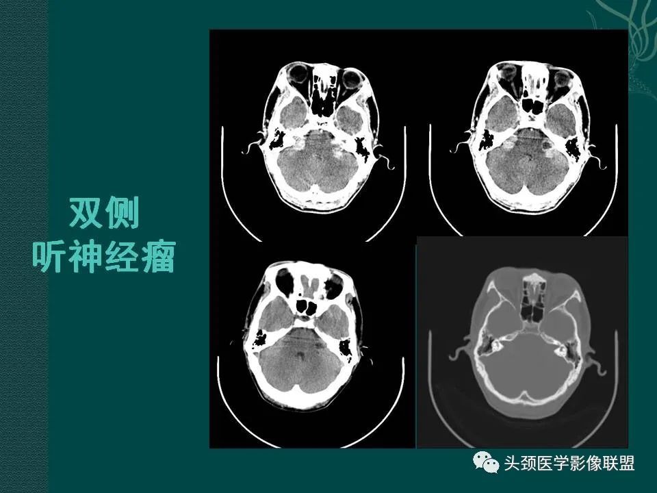 【PPT】耳部常见疾病影像表现-55