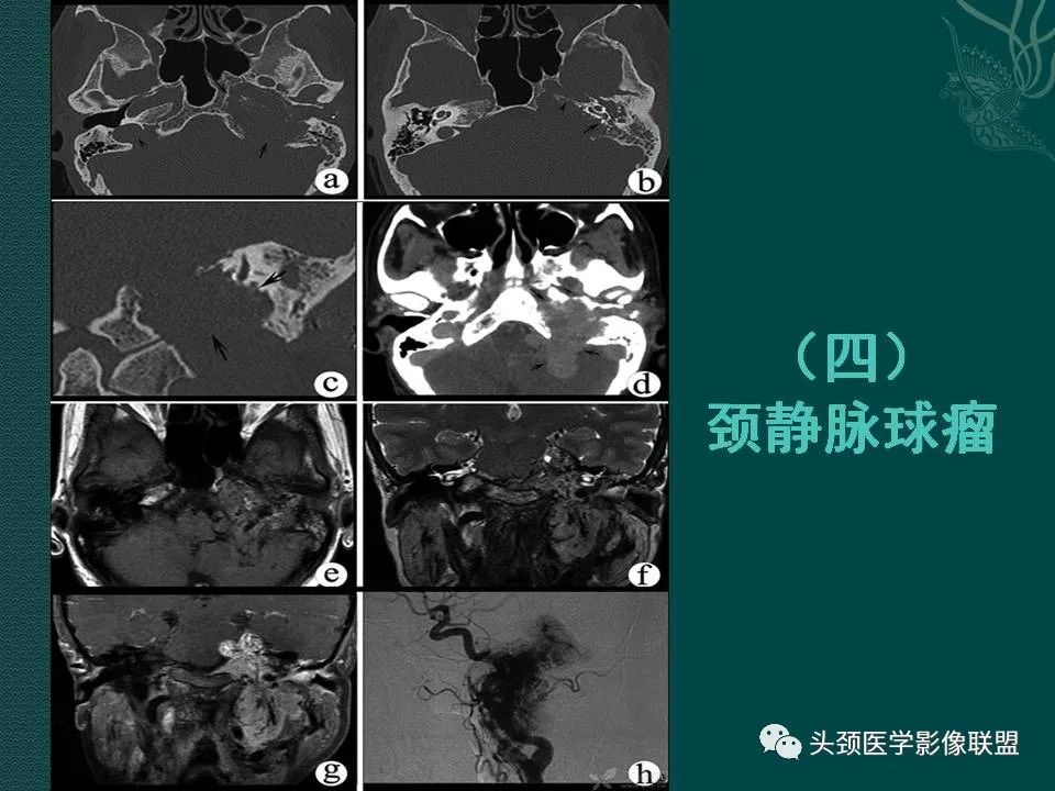 【PPT】耳部常见疾病影像表现-57
