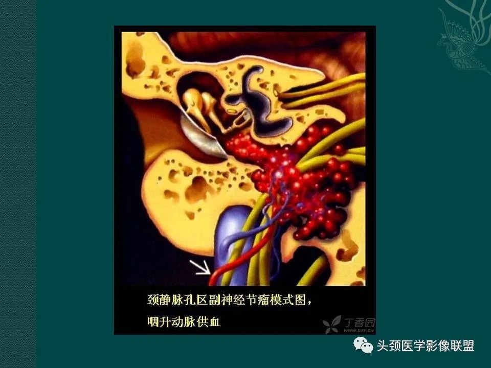 【PPT】耳部常见疾病影像表现-58