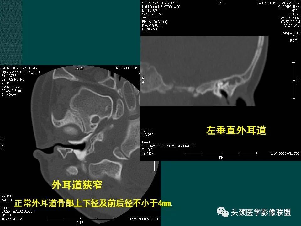 【PPT】耳部常见疾病影像表现-62