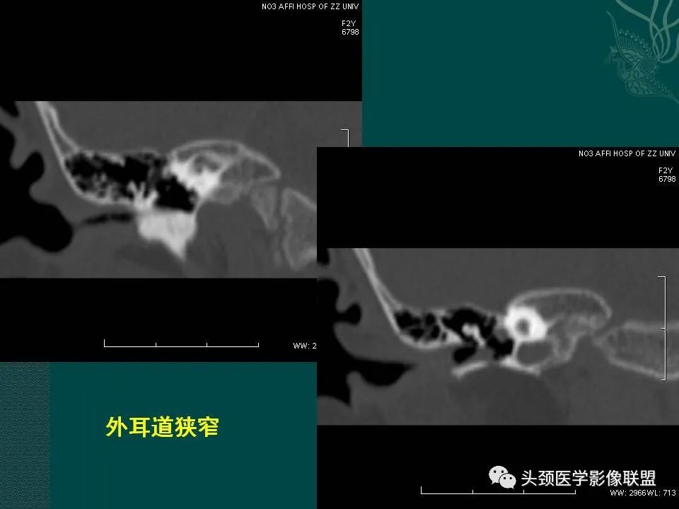 【PPT】耳部常见疾病影像表现-63