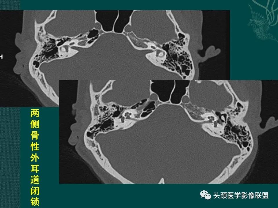 【PPT】耳部常见疾病影像表现-65