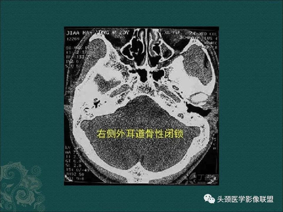 【PPT】耳部常见疾病影像表现-64