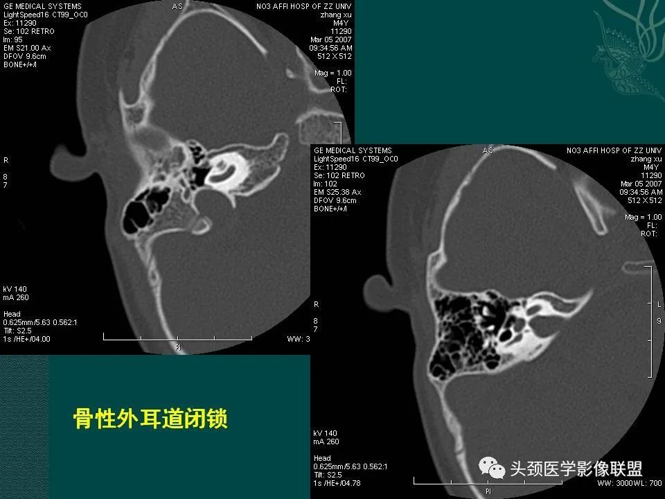 【PPT】耳部常见疾病影像表现-66
