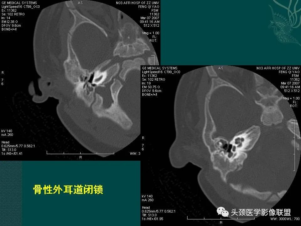 【PPT】耳部常见疾病影像表现-67