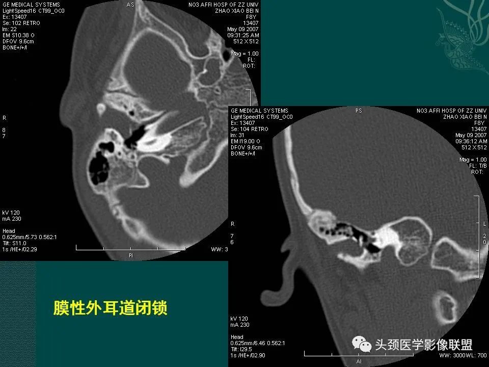 【PPT】耳部常见疾病影像表现-68