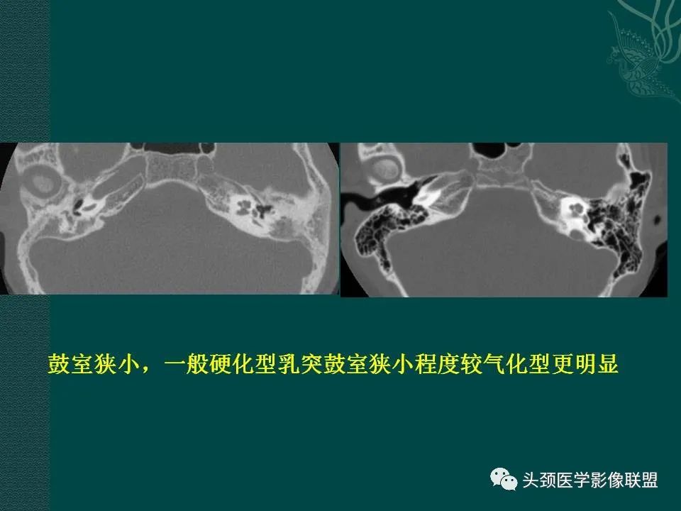 【PPT】耳部常见疾病影像表现-70