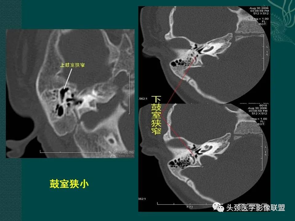【PPT】耳部常见疾病影像表现-71
