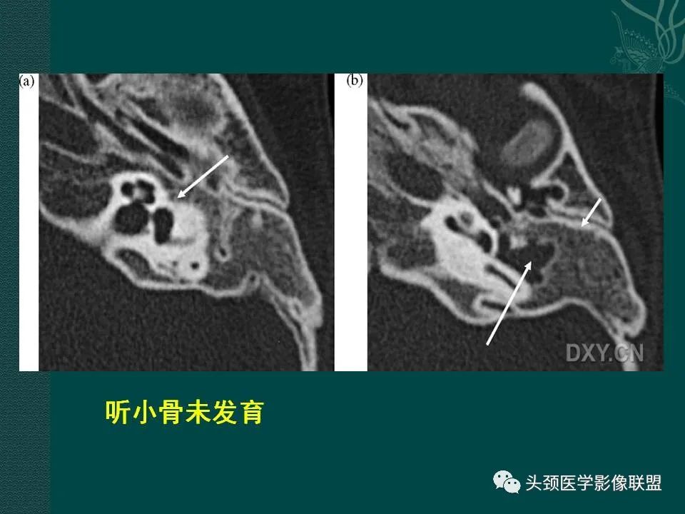 【PPT】耳部常见疾病影像表现-72