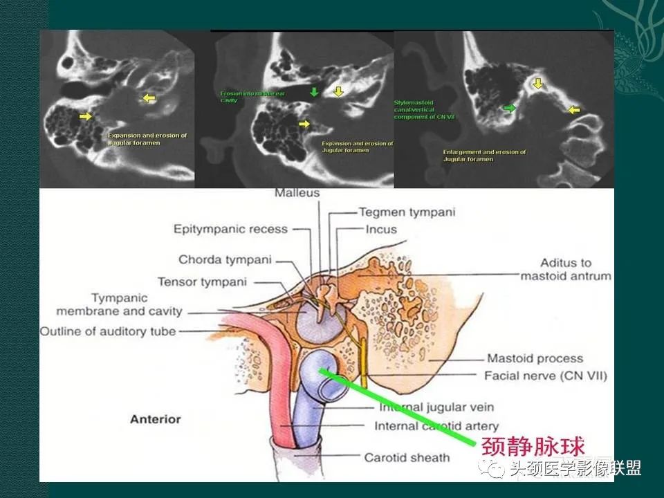 【PPT】耳部常见疾病影像表现-75