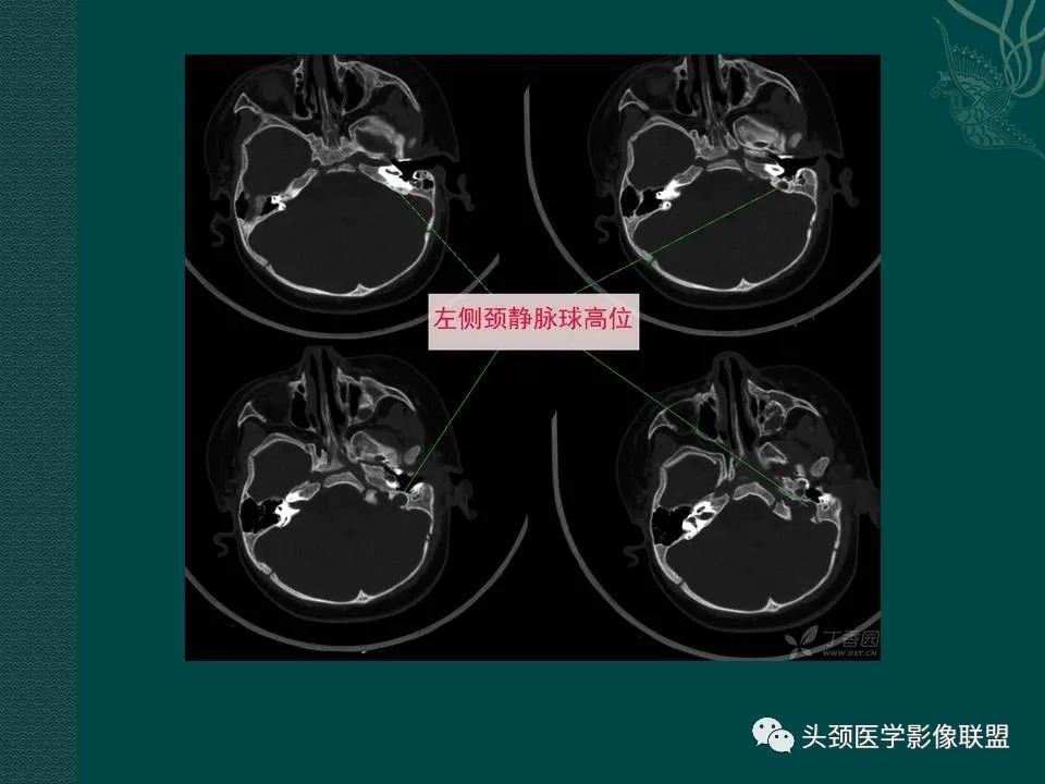 【PPT】耳部常见疾病影像表现-76
