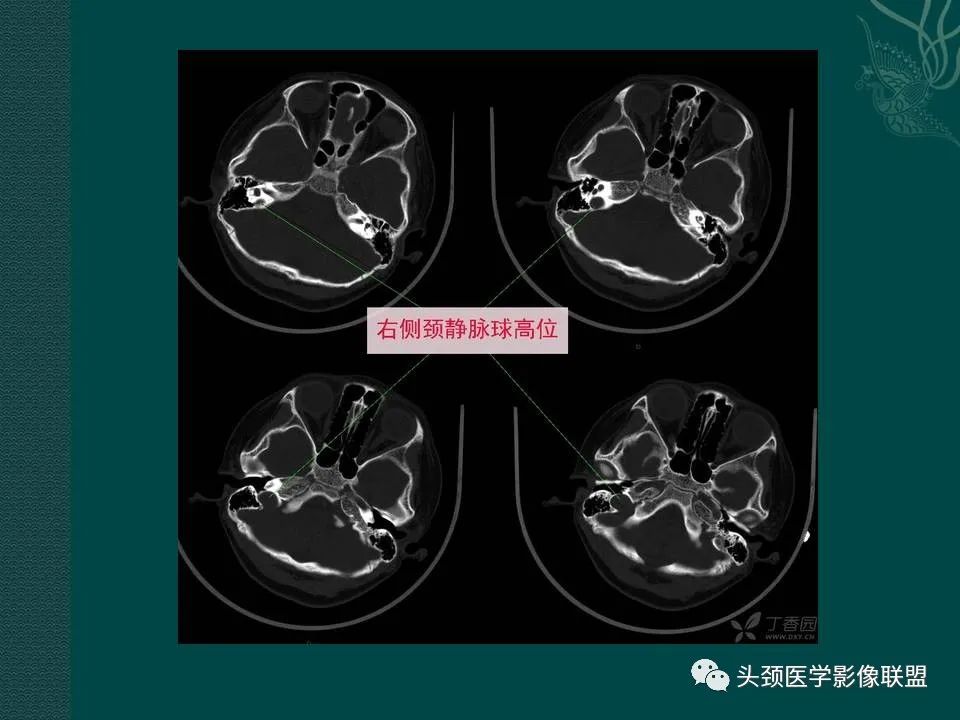 【PPT】耳部常见疾病影像表现-77