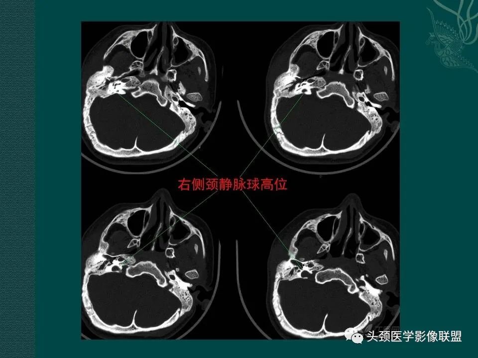 【PPT】耳部常见疾病影像表现-78