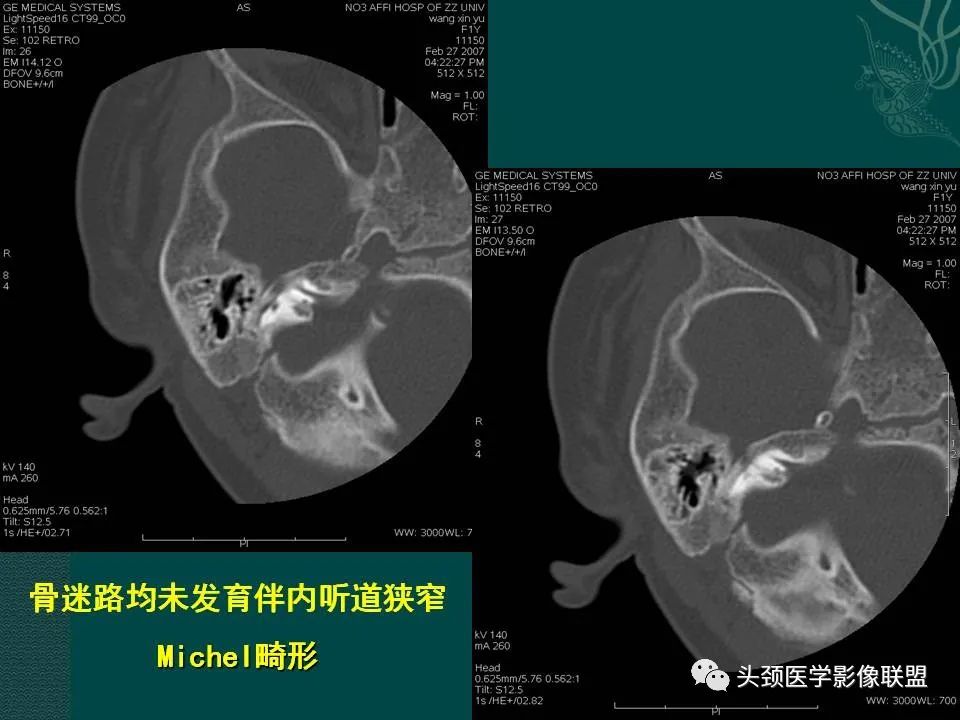 【PPT】耳部常见疾病影像表现-80