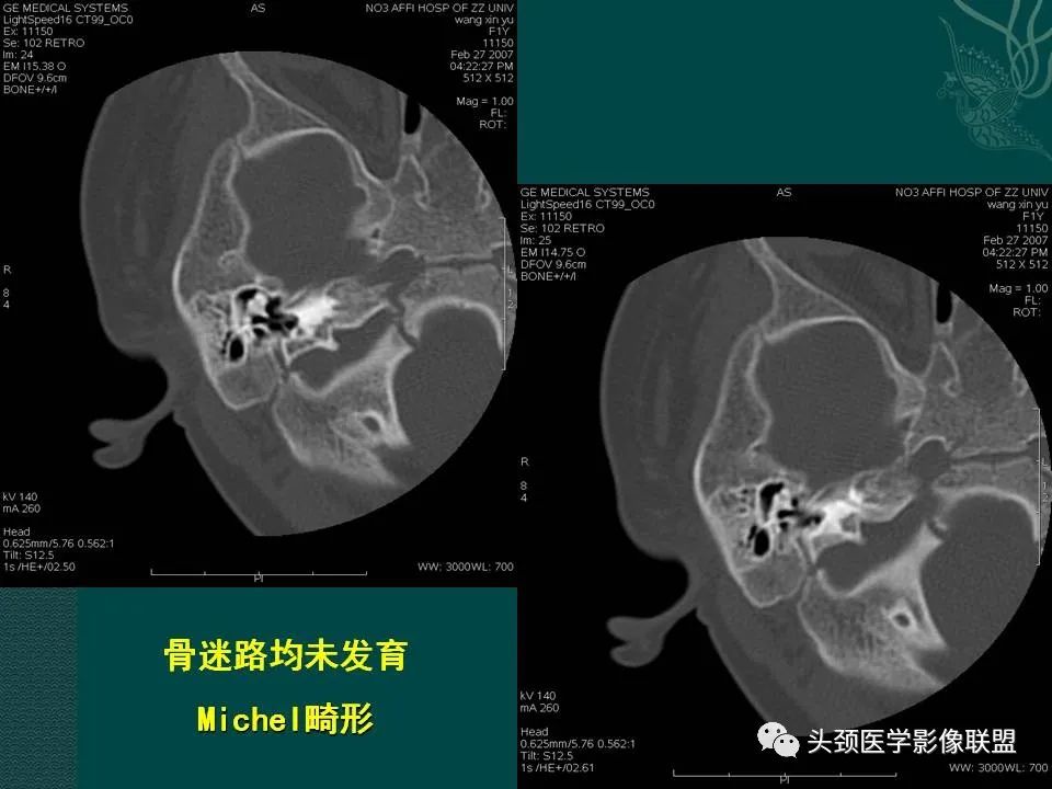 【PPT】耳部常见疾病影像表现-81