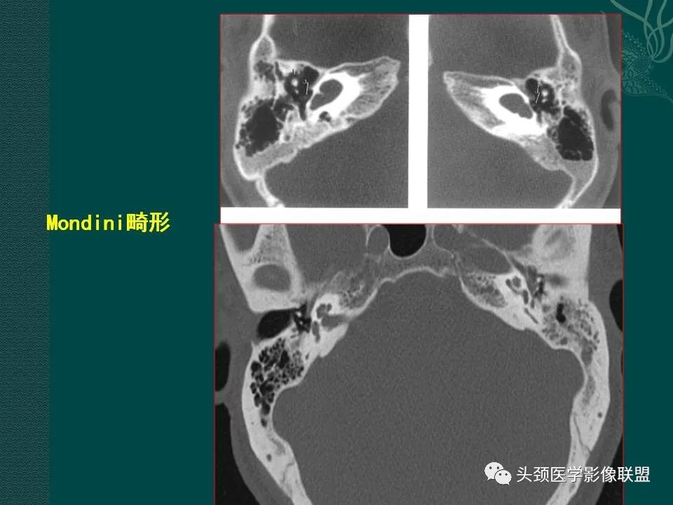 【PPT】耳部常见疾病影像表现-82