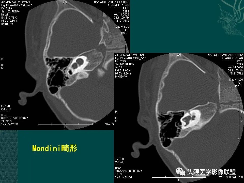 【PPT】耳部常见疾病影像表现-83