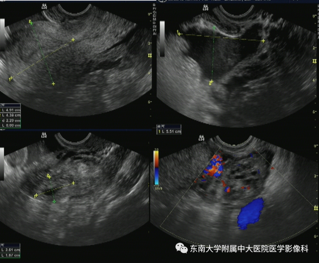 【PPT】常见妇科急腹症的超声-放射诊断-1