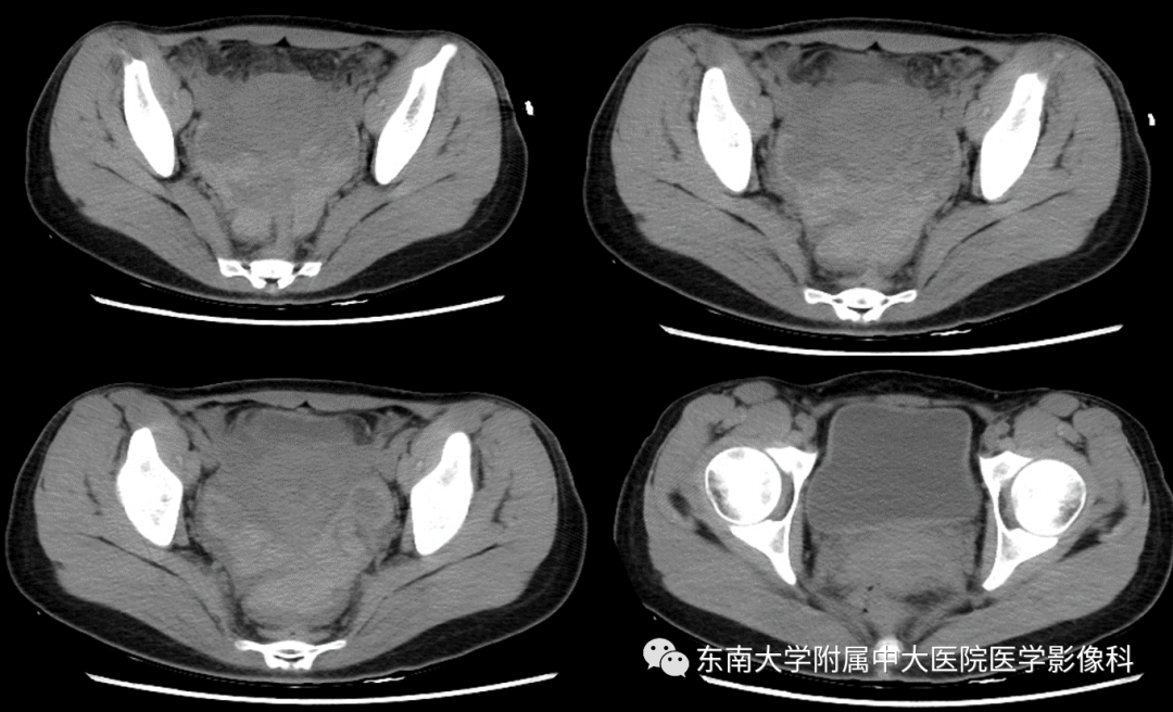 【PPT】常见妇科急腹症的超声-放射诊断-2