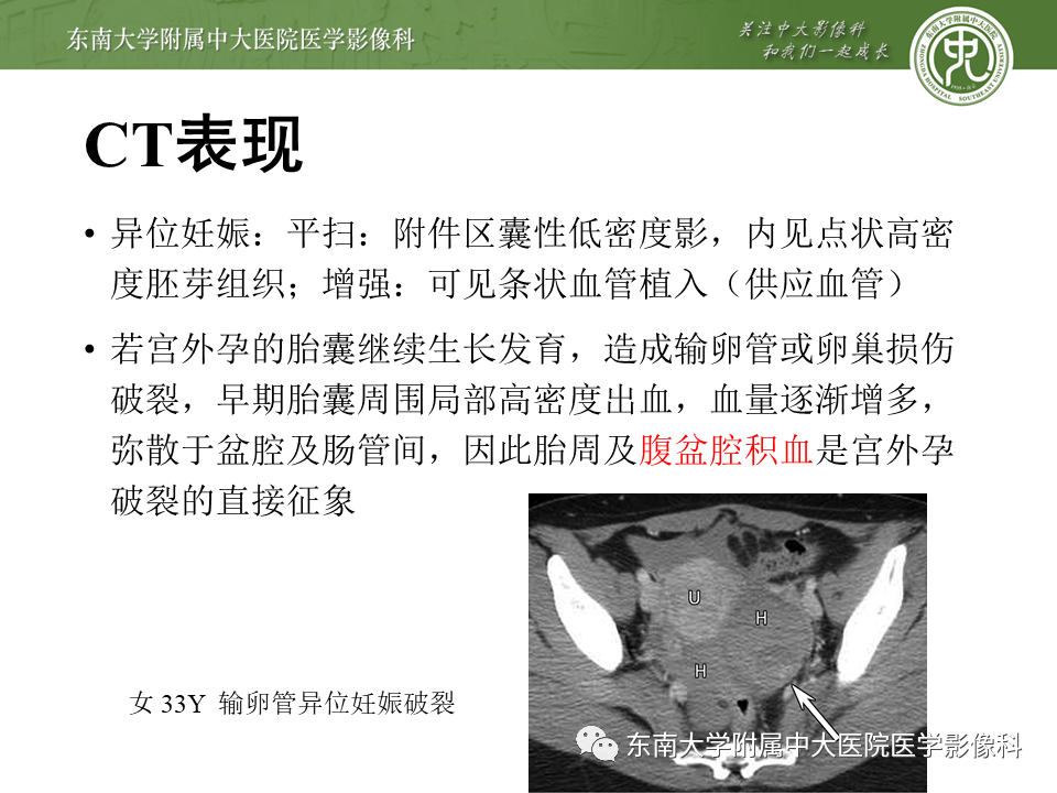 【PPT】常见妇科急腹症的超声-放射诊断-13