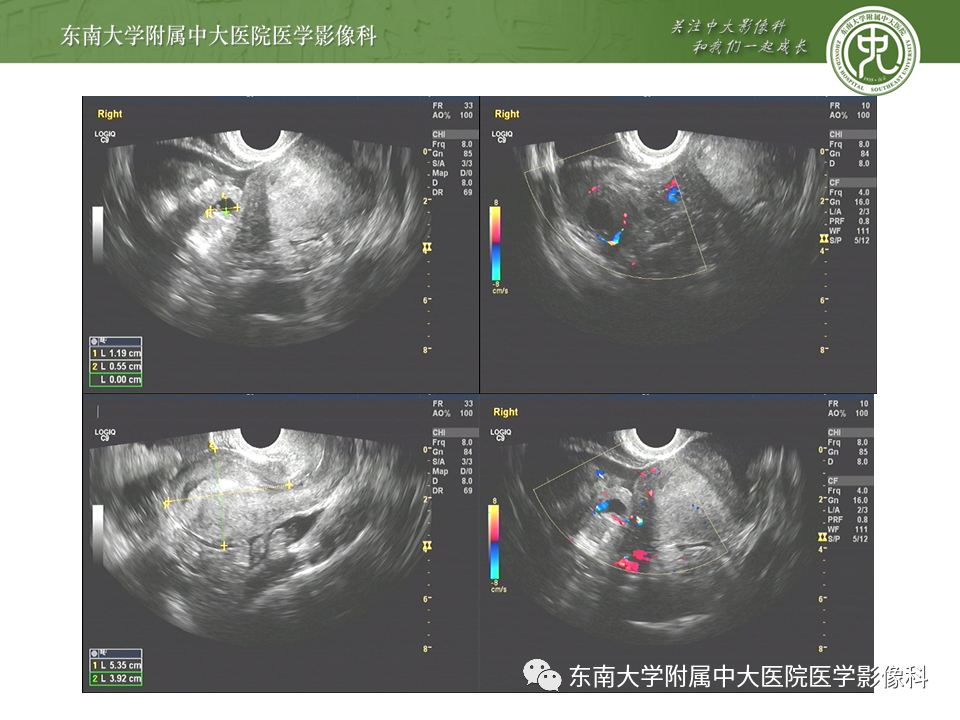【PPT】常见妇科急腹症的超声-放射诊断-12