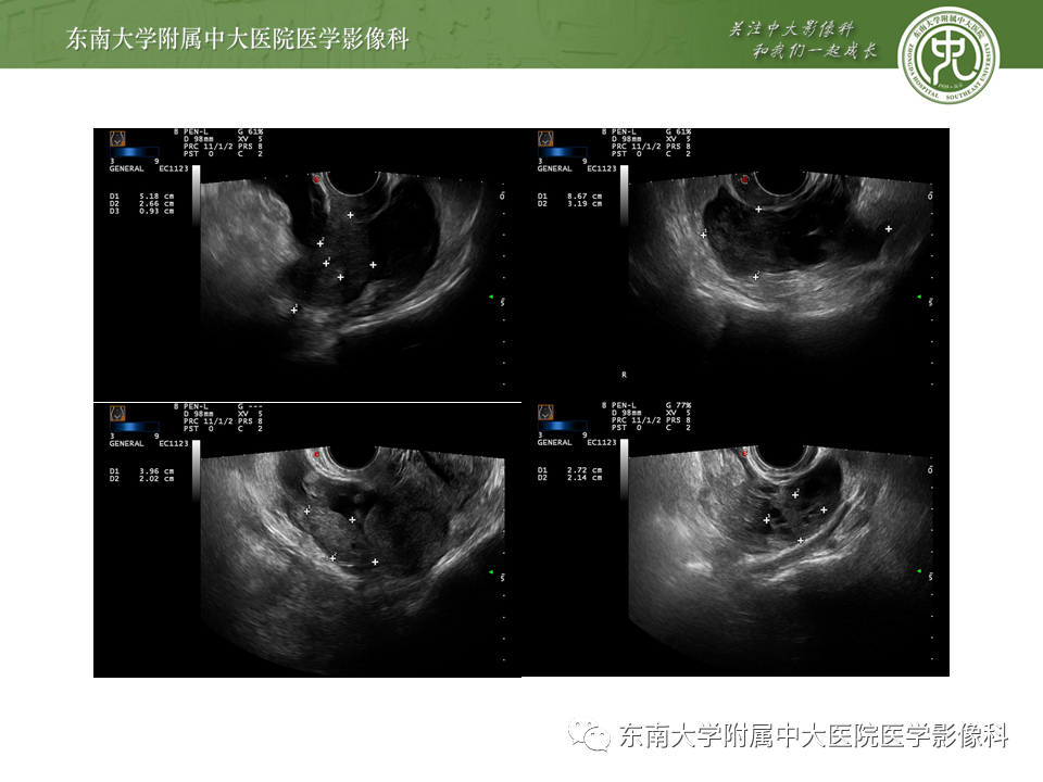 【PPT】常见妇科急腹症的超声-放射诊断-14