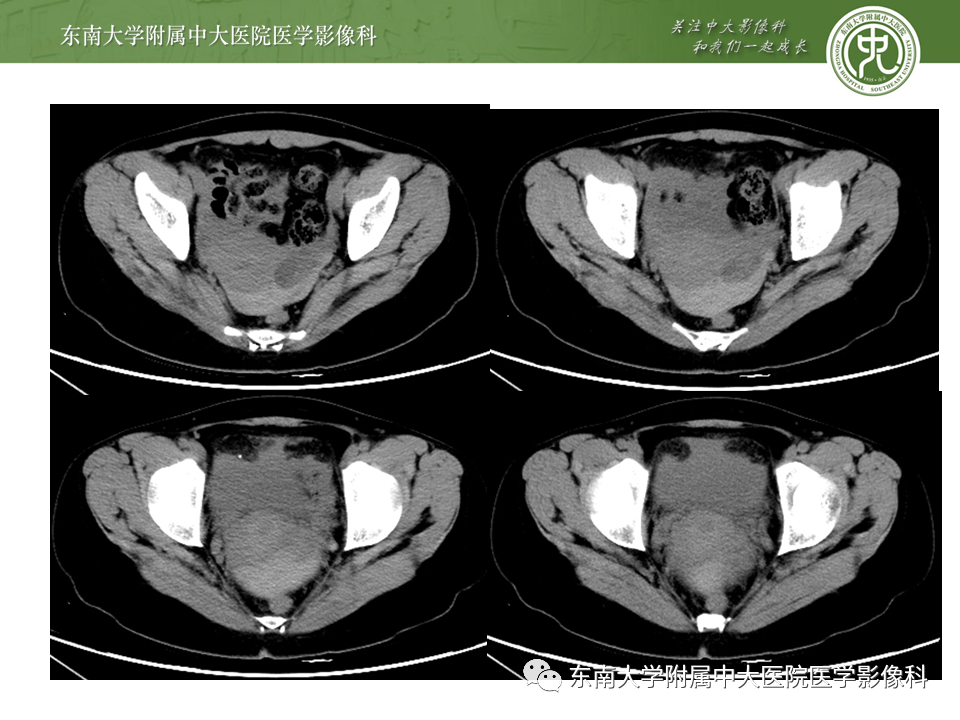 【PPT】常见妇科急腹症的超声-放射诊断-15