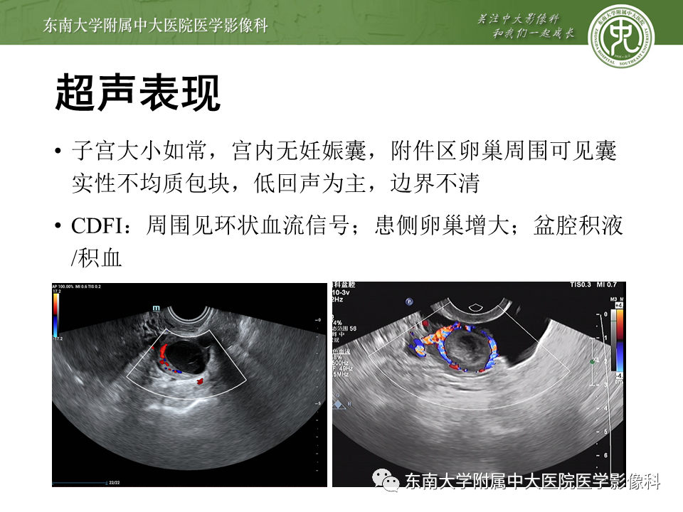 【PPT】常见妇科急腹症的超声-放射诊断-18