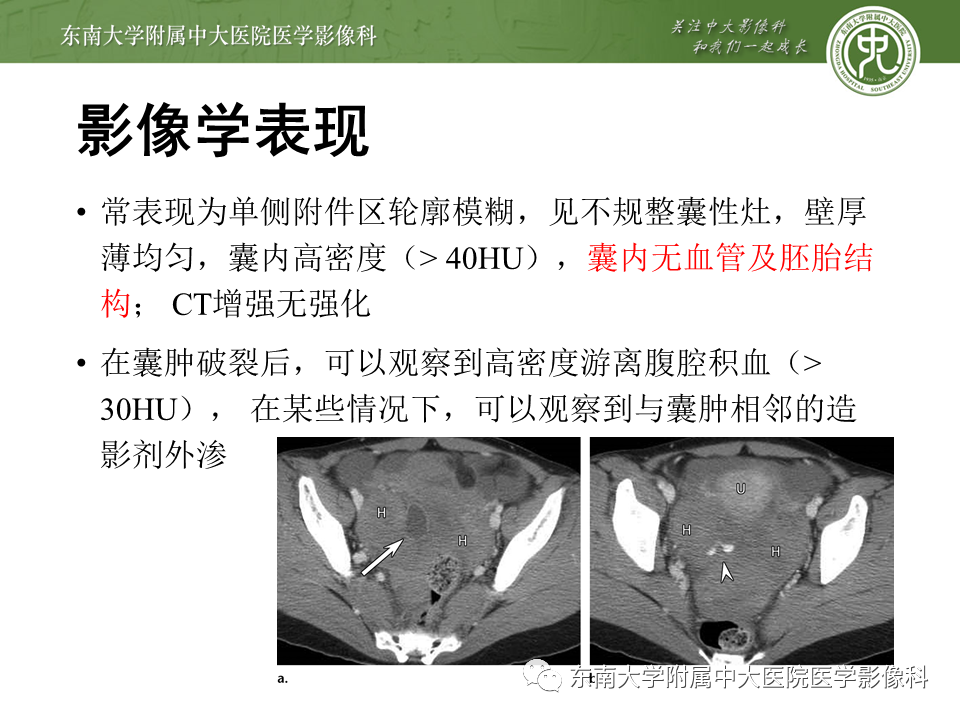 【PPT】常见妇科急腹症的超声-放射诊断-19