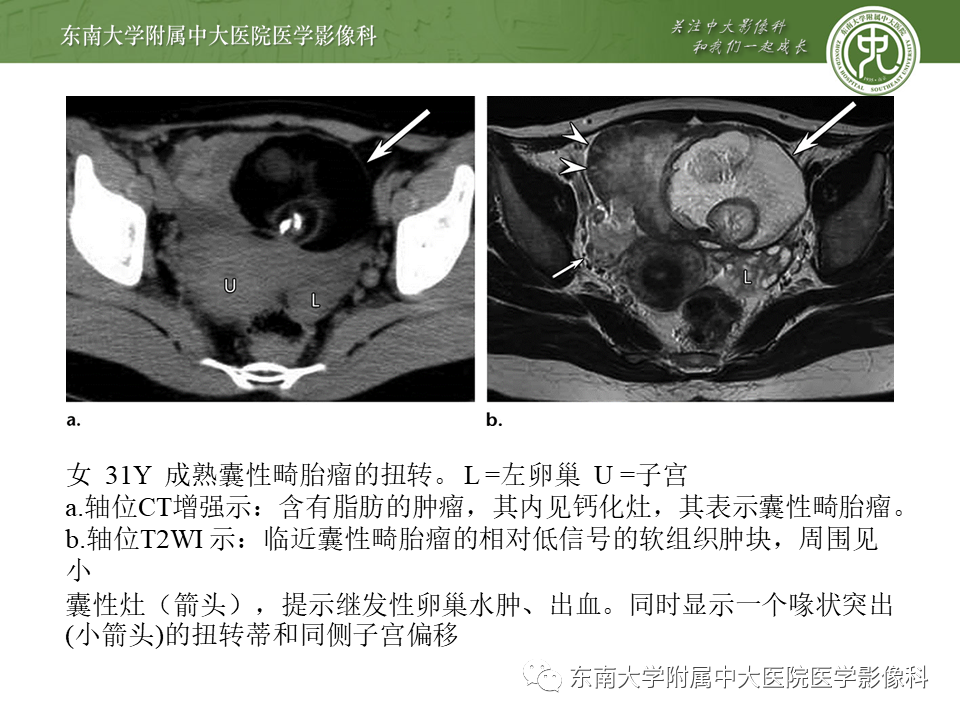 【PPT】常见妇科急腹症的超声-放射诊断-24