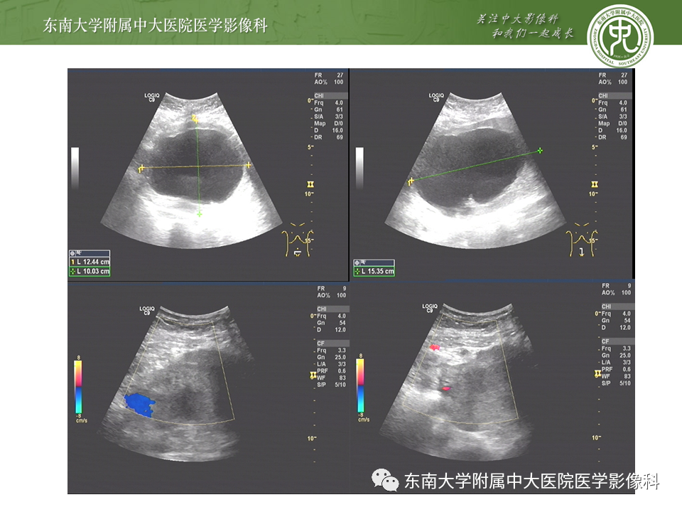 【PPT】常见妇科急腹症的超声-放射诊断-25