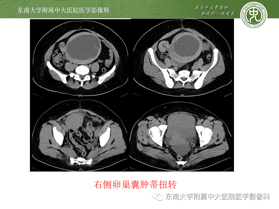 【PPT】常见妇科急腹症的超声-放射诊断-26