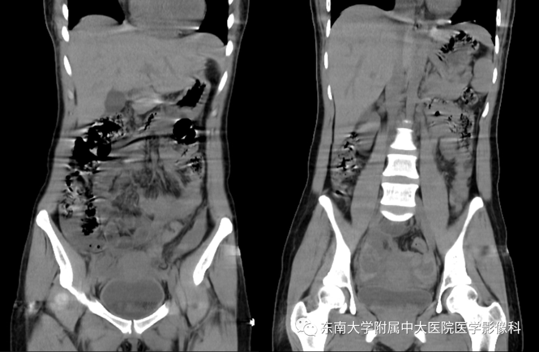 【PPT】常见妇科急腹症的超声-放射诊断-1