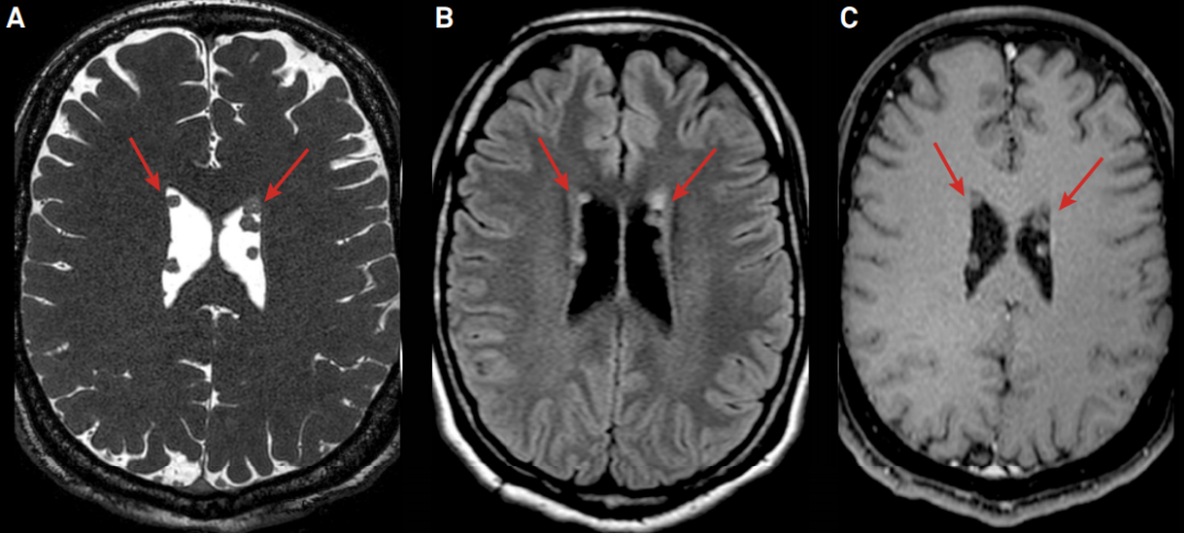 【病例】见过就不会忘的环状侧脑室结节-3
