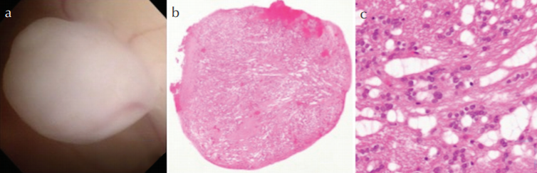 【病例】见过就不会忘的环状侧脑室结节-2