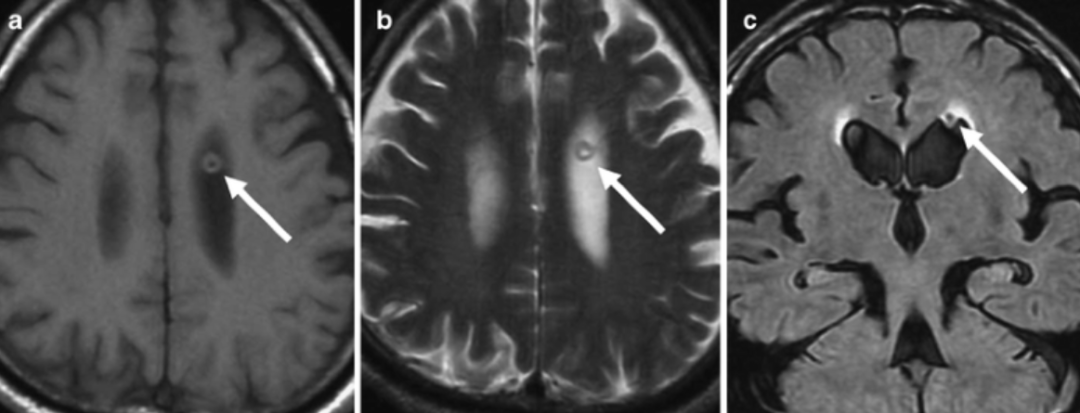 【病例】见过就不会忘的环状侧脑室结节-4