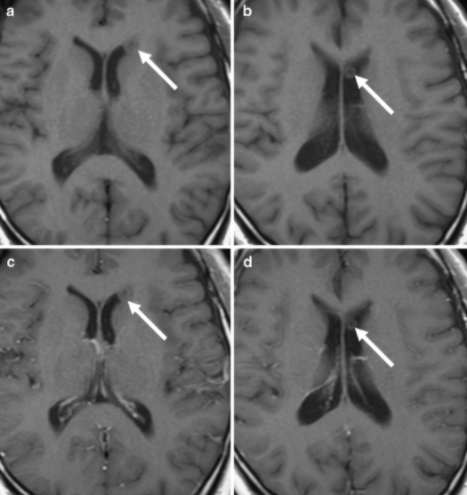 【病例】见过就不会忘的环状侧脑室结节-5