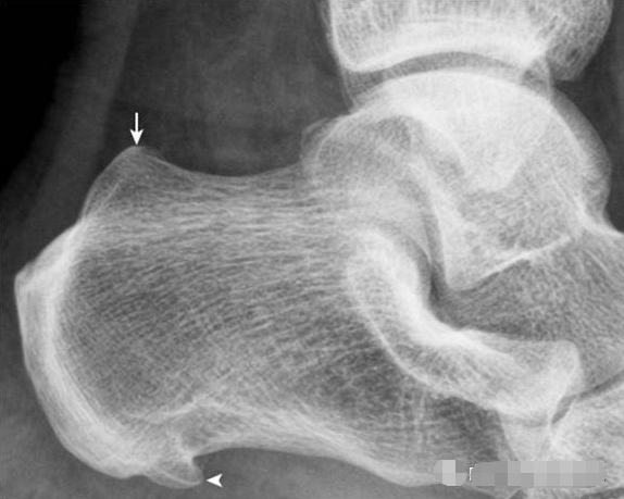足部正常的及常见病变的 X 线表现-2