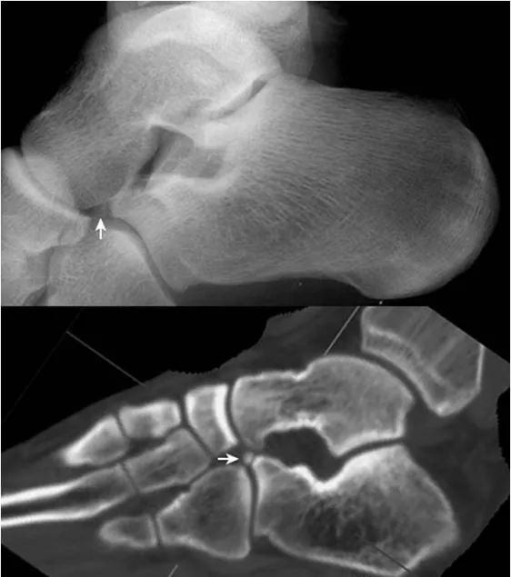 足部正常的及常见病变的 X 线表现-6