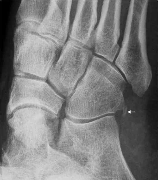 足部正常的及常见病变的 X 线表现-7