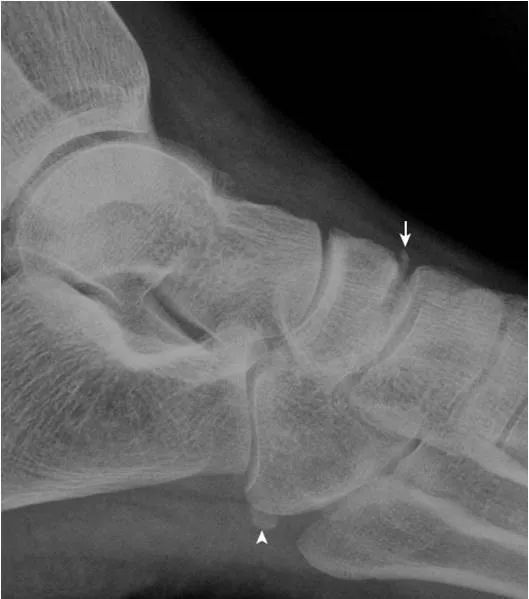 足部正常的及常见病变的 X 线表现-9