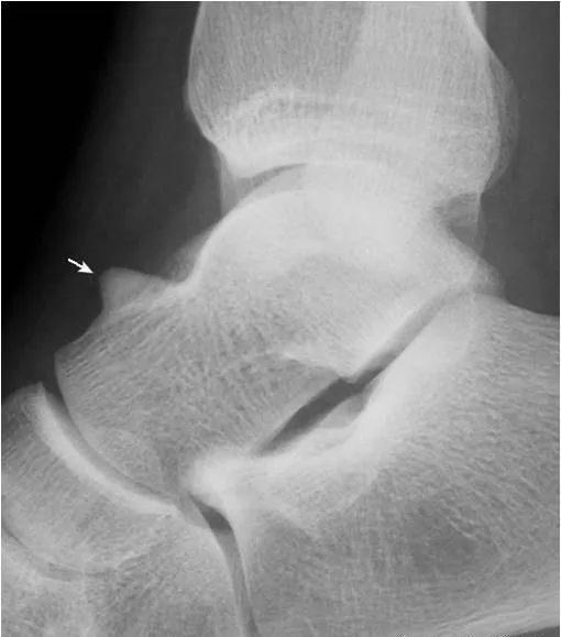 足部正常的及常见病变的 X 线表现-11