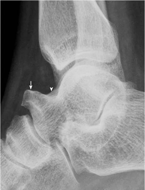 足部正常的及常见病变的 X 线表现-12