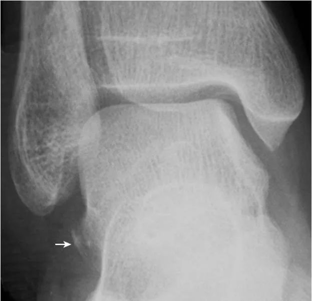 足部正常的及常见病变的 X 线表现-14