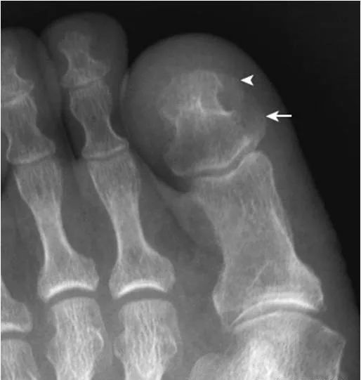 足部正常的及常见病变的 X 线表现-19