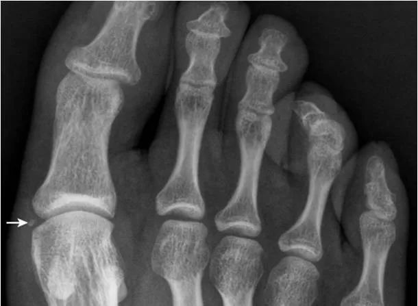 足部正常的及常见病变的 X 线表现-20