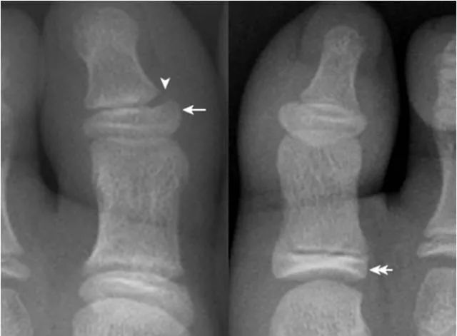 足部正常的及常见病变的 X 线表现-21